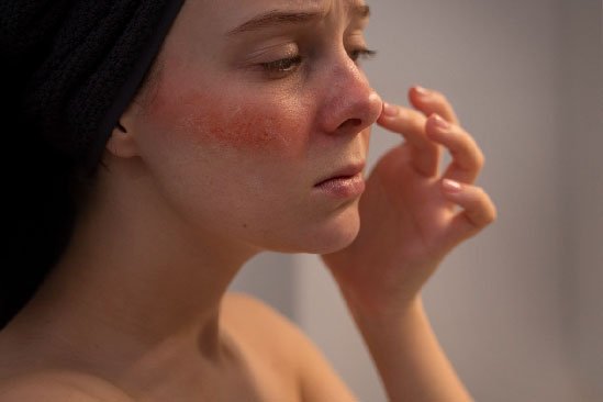 chemical peel in bangalore